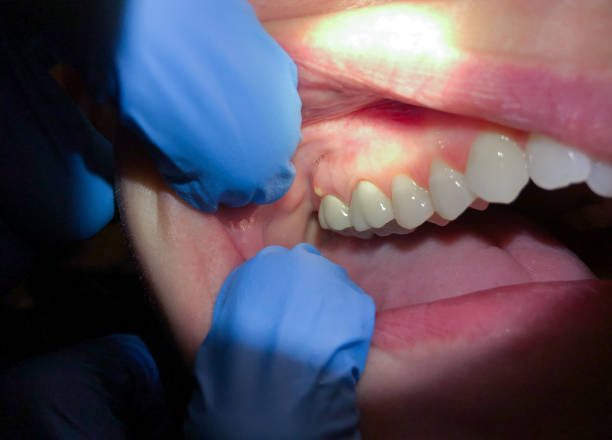 Best Emergency Treatment for Dental Infections or Abscesses in Veneta, OR